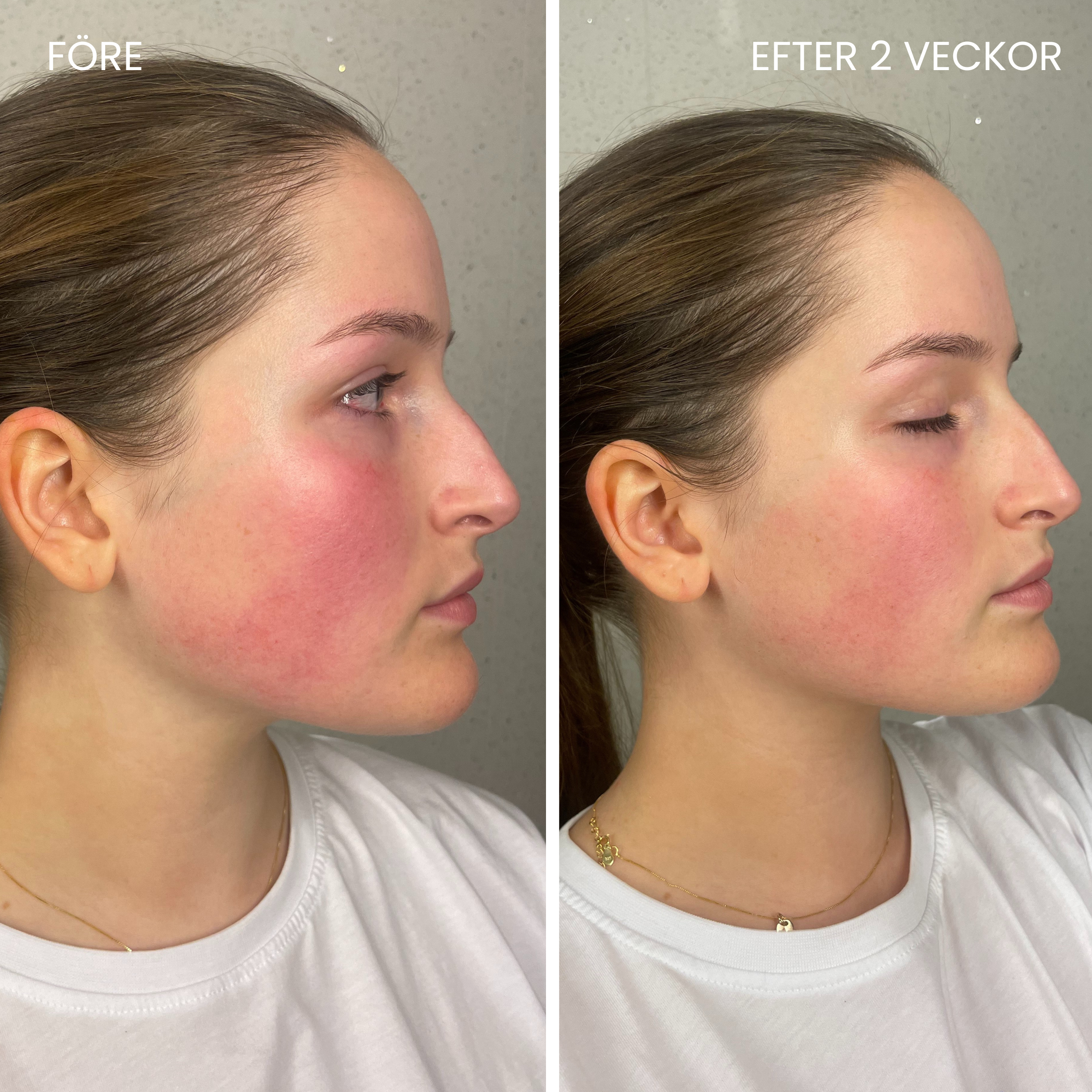 Skinboosting LED-maske